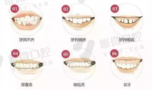 做牙齿树脂贴面是什么材料做的（树脂贴片牙齿颜色有几种）(图1)